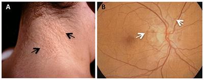 Rare Co-occurrence of Beta-Thalassemia and Pseudoxanthoma elasticum: Novel Biomolecular Findings